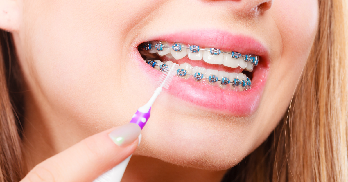Tut Es Weh Eine Feste Zahnspange Zu Entfernen Der ultimative Putz-Guide für feste Zahnspangen