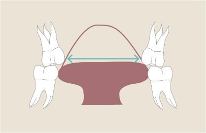 Gaumennahterweiterung