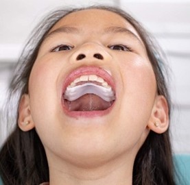 IPE (Invisalign palatinal Expander)
