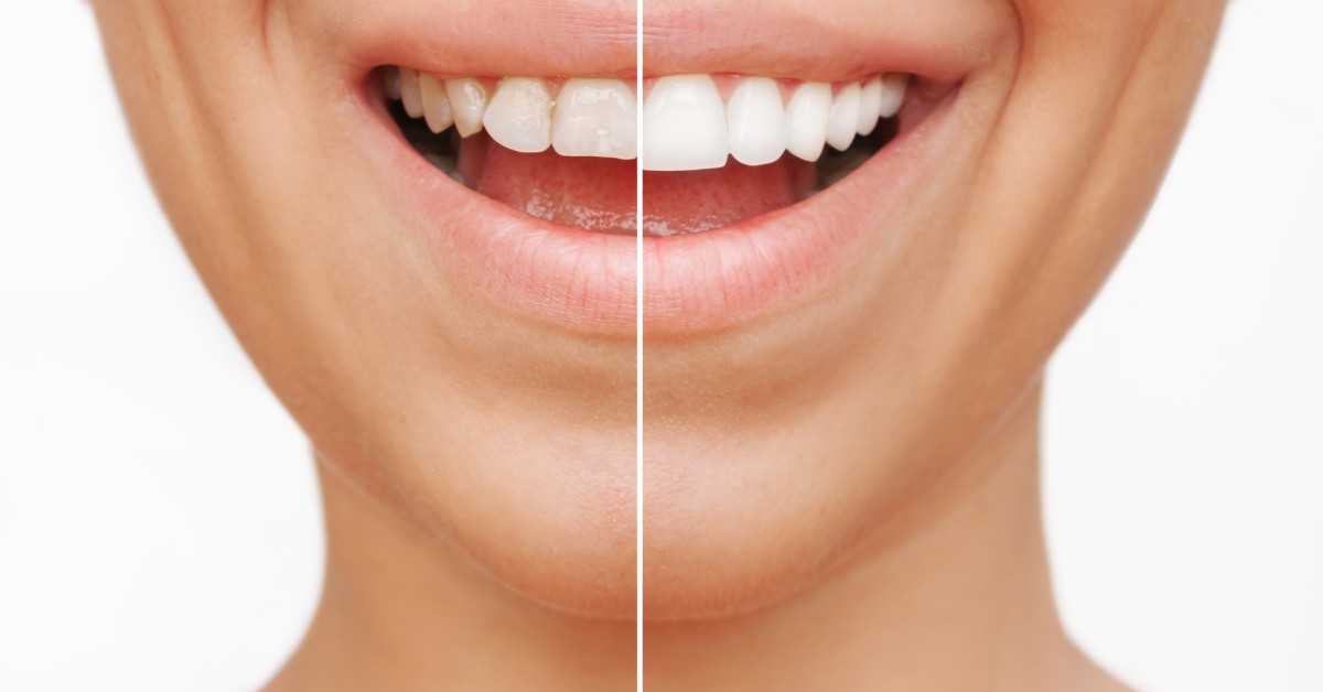 Veneers Wie funktioniert das? medondo.health
