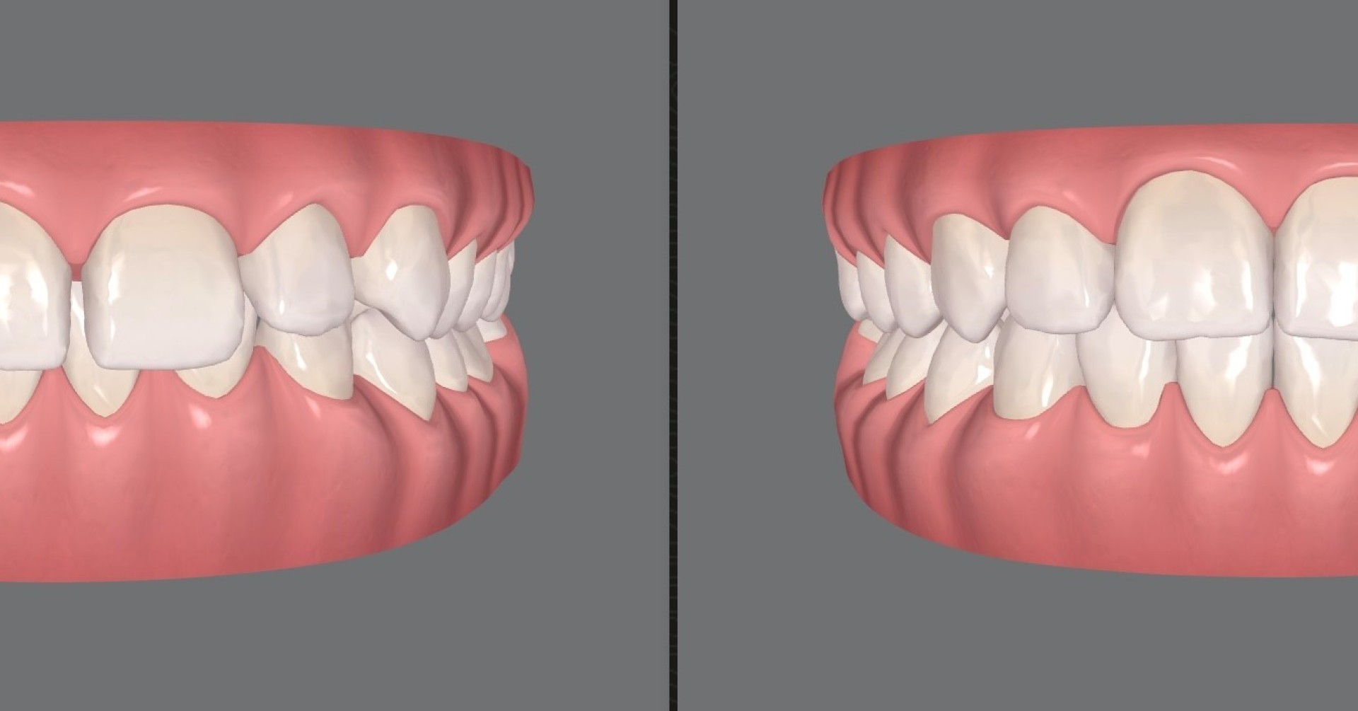 Simulation einer kieferorthopädischen Behandlung mit Alignern