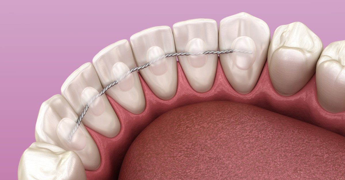 Die lebenslange Garantie: Warum der Retainer-Check einmal im Jahr so ...