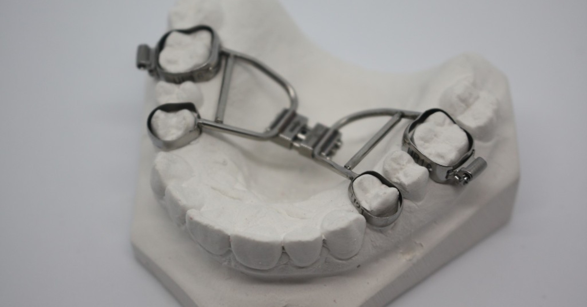 Gaumennahterweiterungs-Apparatur mit Bändern