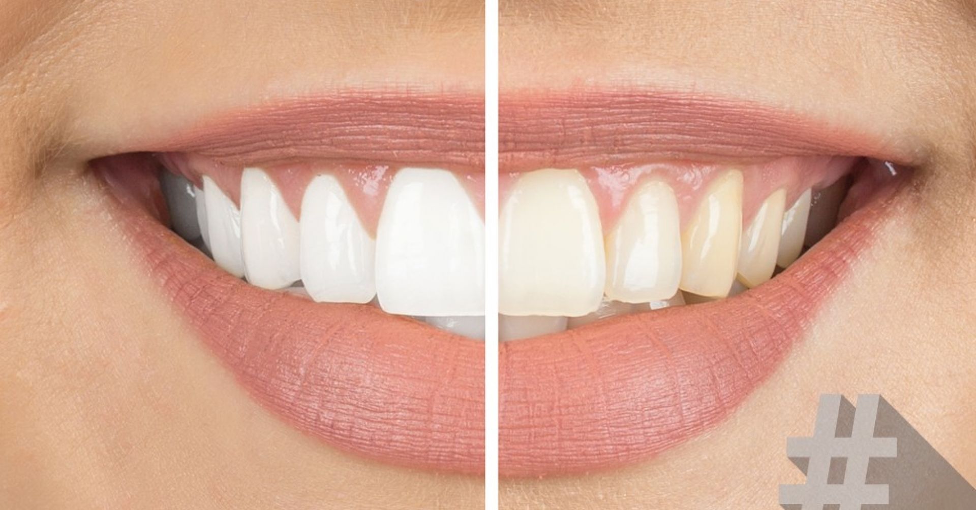 Bleaching vorher-nachher